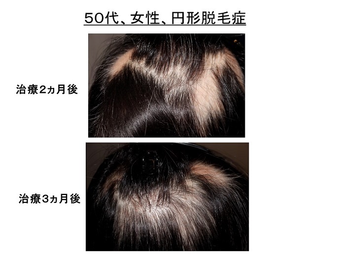 円形脱毛症　病院